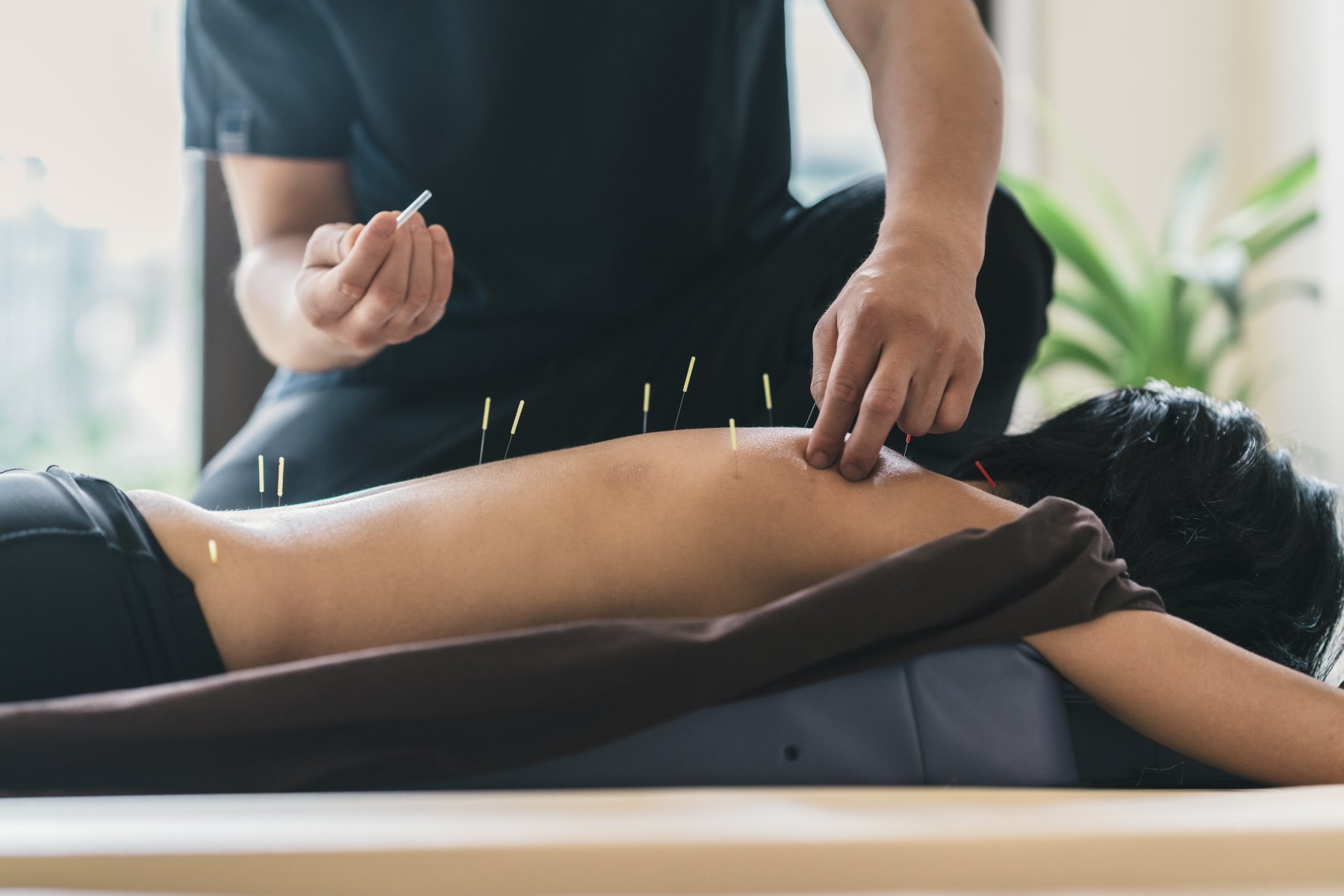 acupuncture_theramotion_physical_therapy